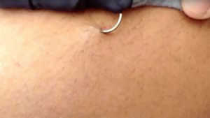 How to Remove a Fishing Hook from Skin